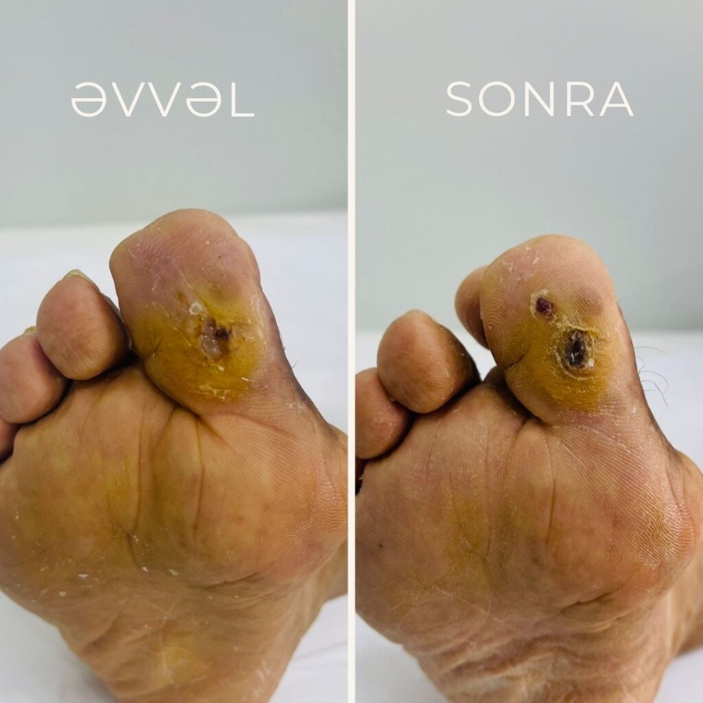 diabetik ayaq müalicəsi