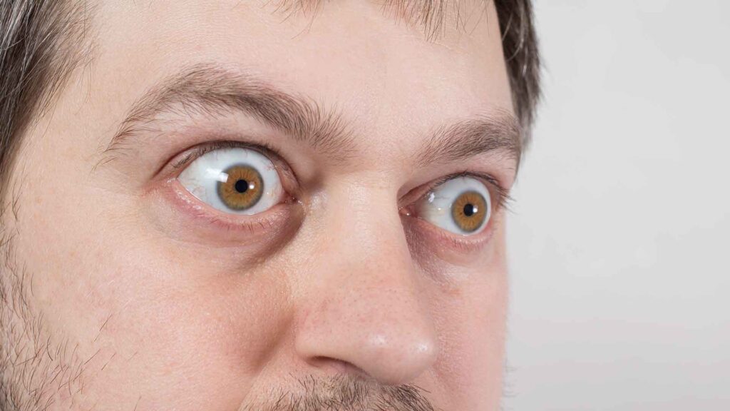 Qreyvs xəstəliyi nədir?