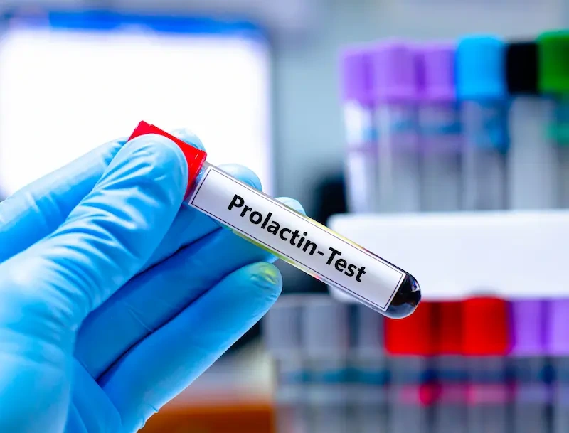 Prolaktin hormonu yüksəkliyi: Səbəblər, əlamətlər və müalicəsi